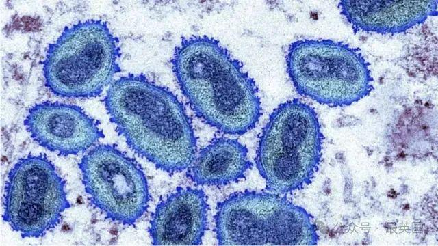 肯尼亚报告首例猴痘死亡病例，疫情观点分析