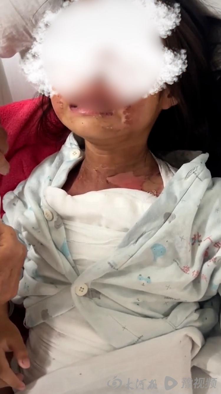 女童被高年级男生泼水烫伤事件曝光，校方作出回应