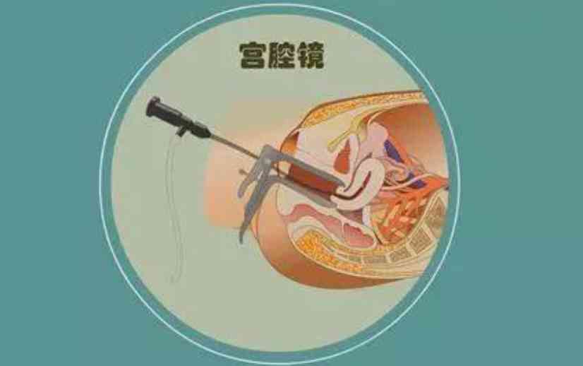 宫腔镜检查价格详解，全面综合论述