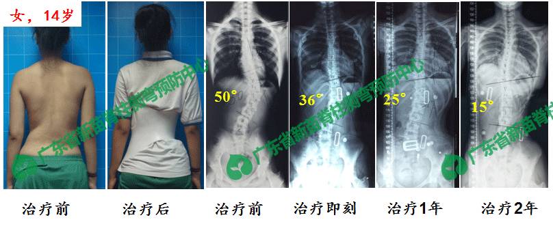脊柱侧弯最新治疗技术观点论述