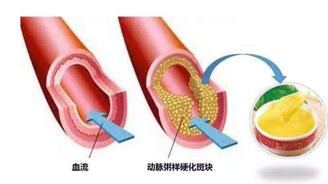 颈动脉斑块最新治疗方案，自信与成就感的源泉，引领健康新未来